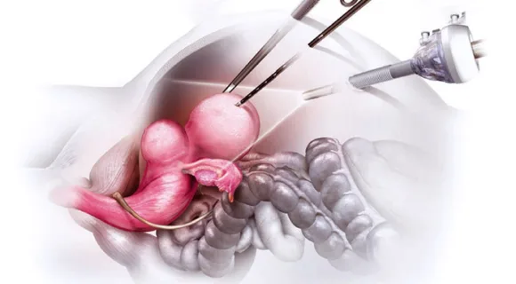 fibroids sketch